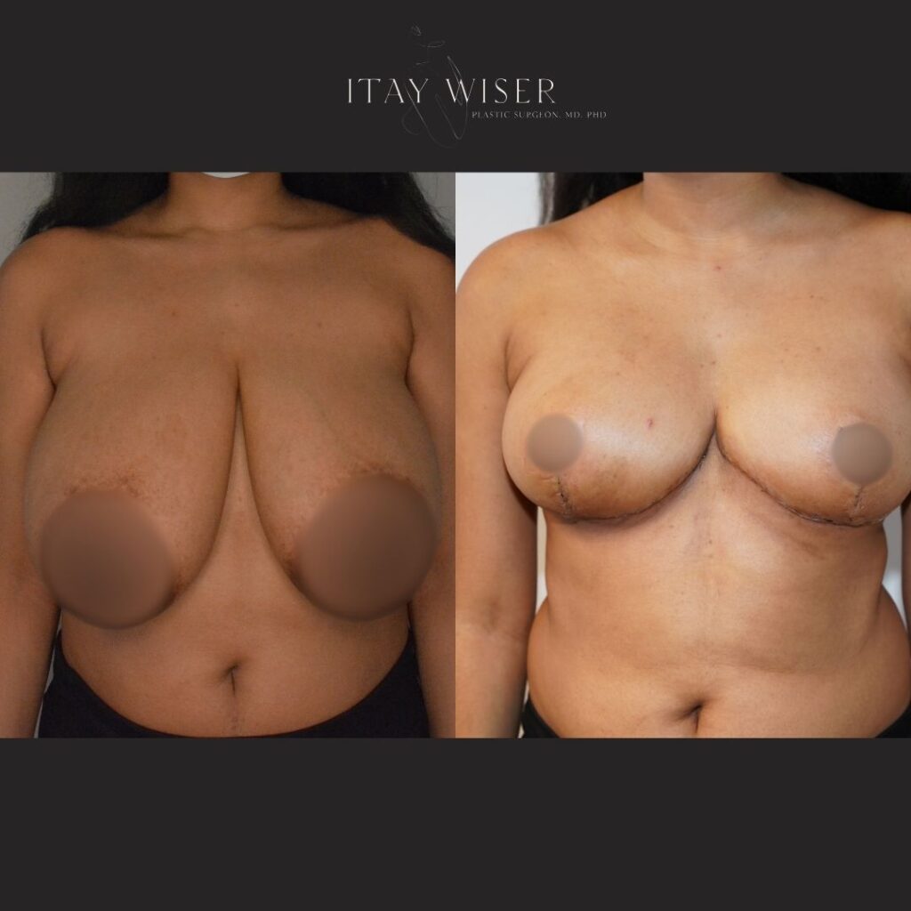 Breast reduction