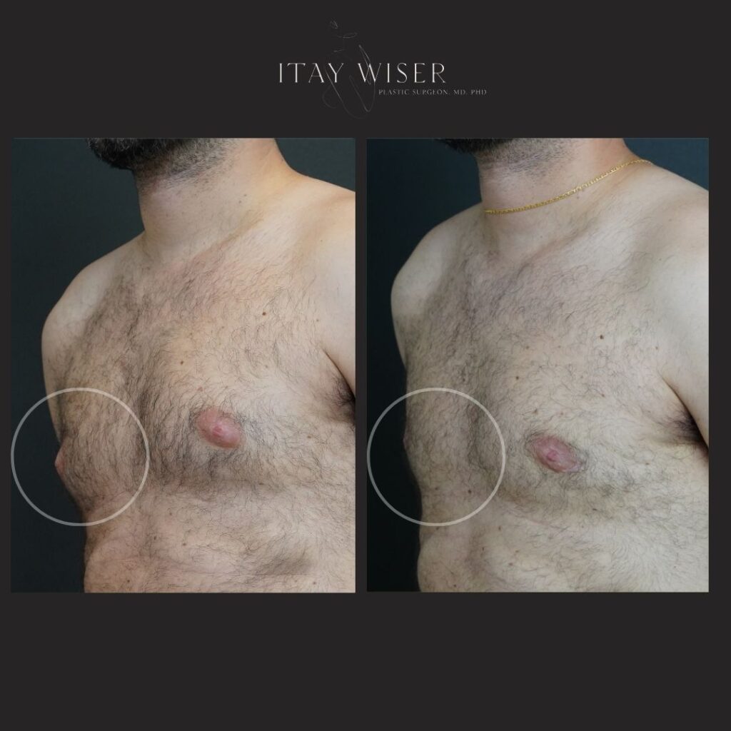 Gynecomastia