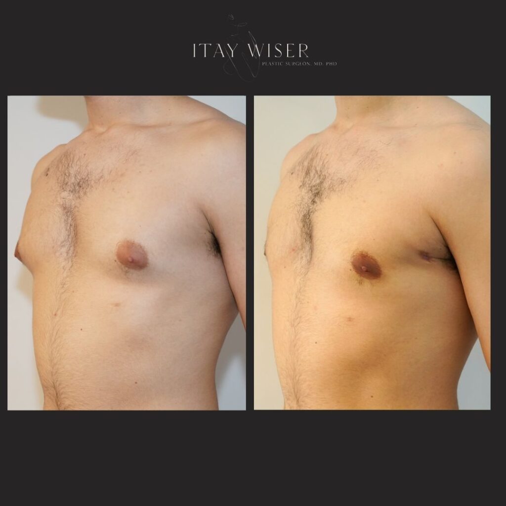 Gynecomastia