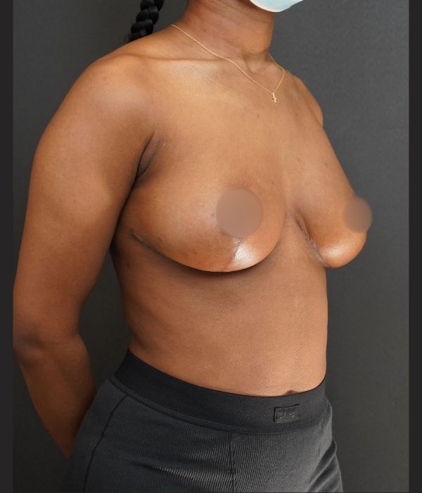 breast reduction
