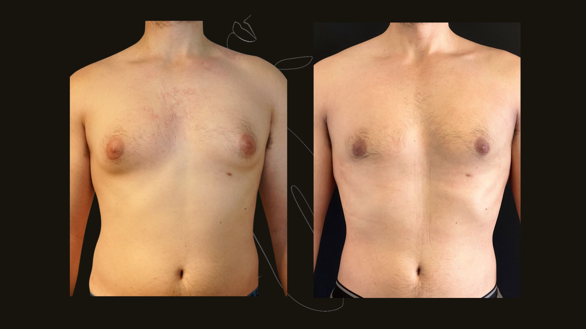Gynecomastia
