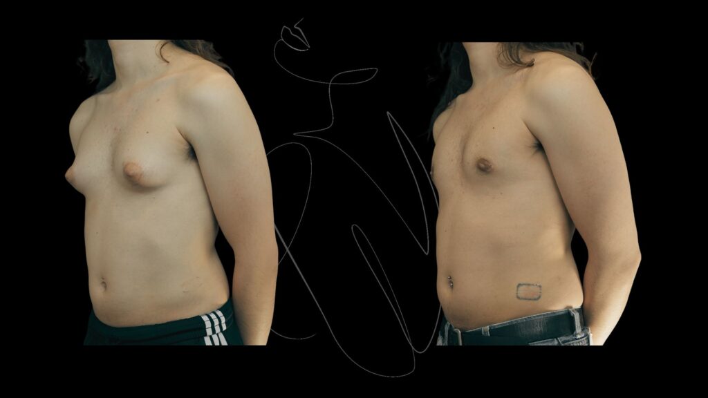Gynecomastia