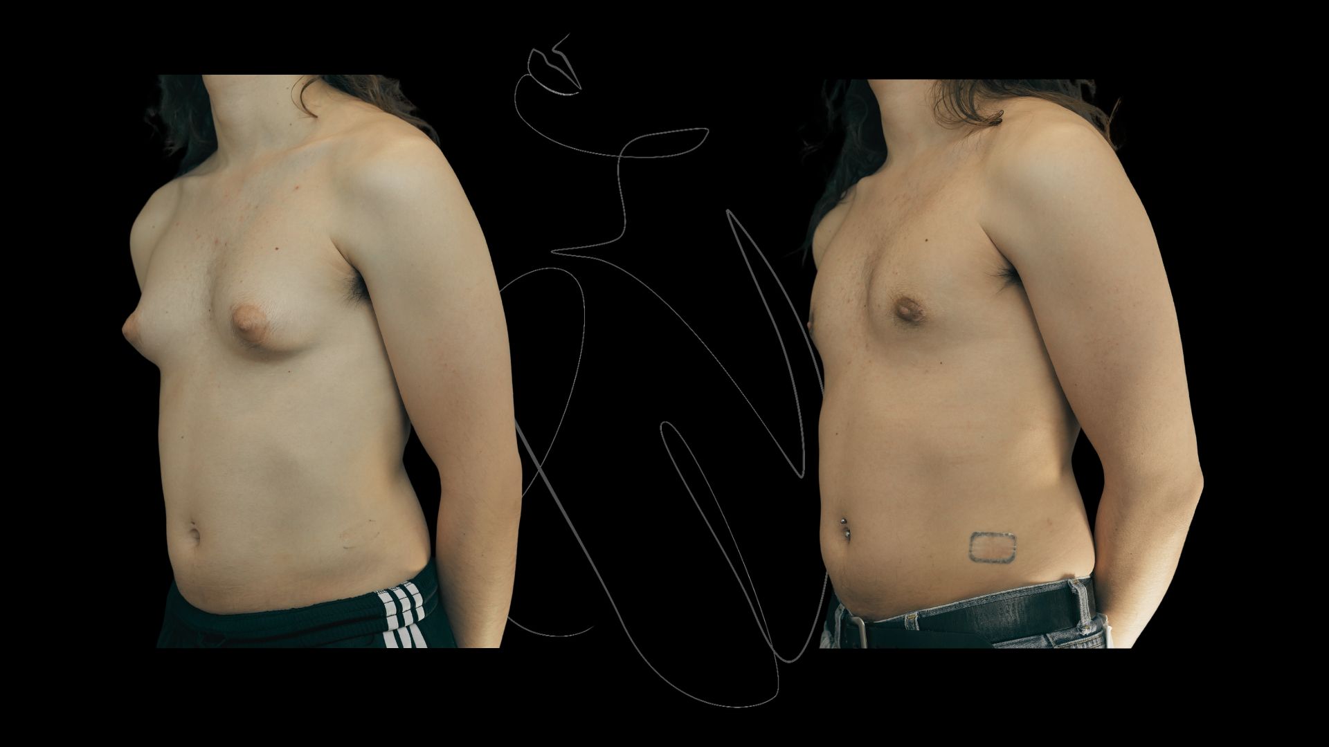 Gynecomastia