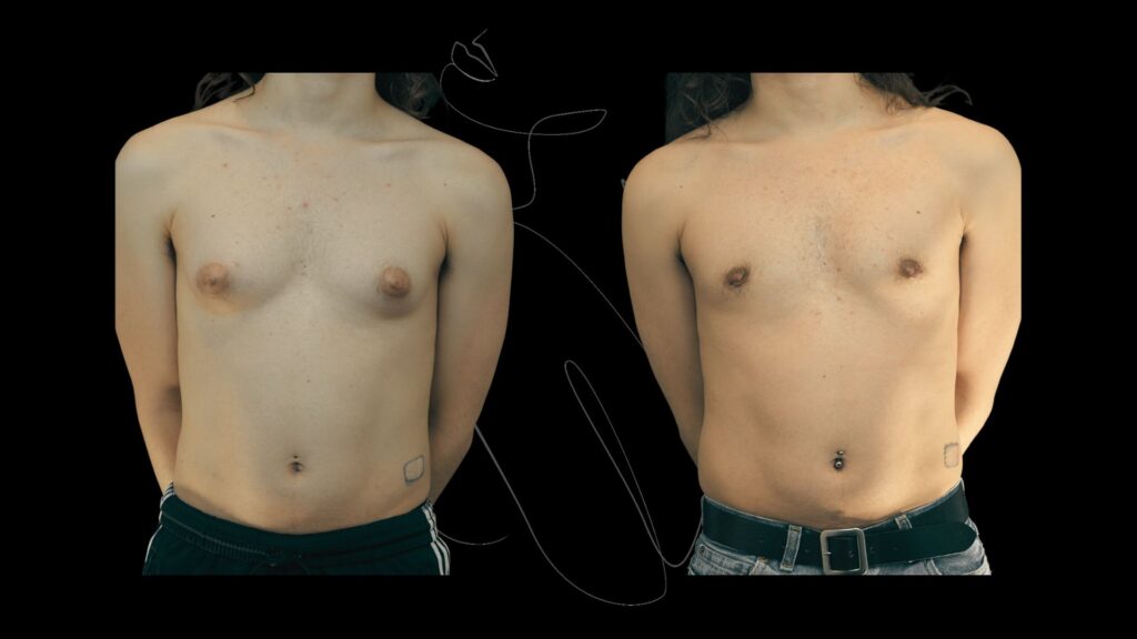 Gynecomastia