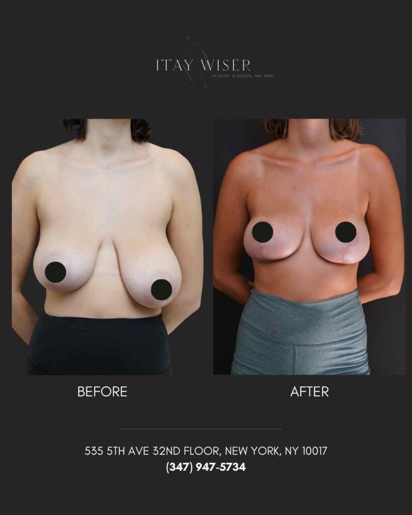 Breast Asymmetry in NYC