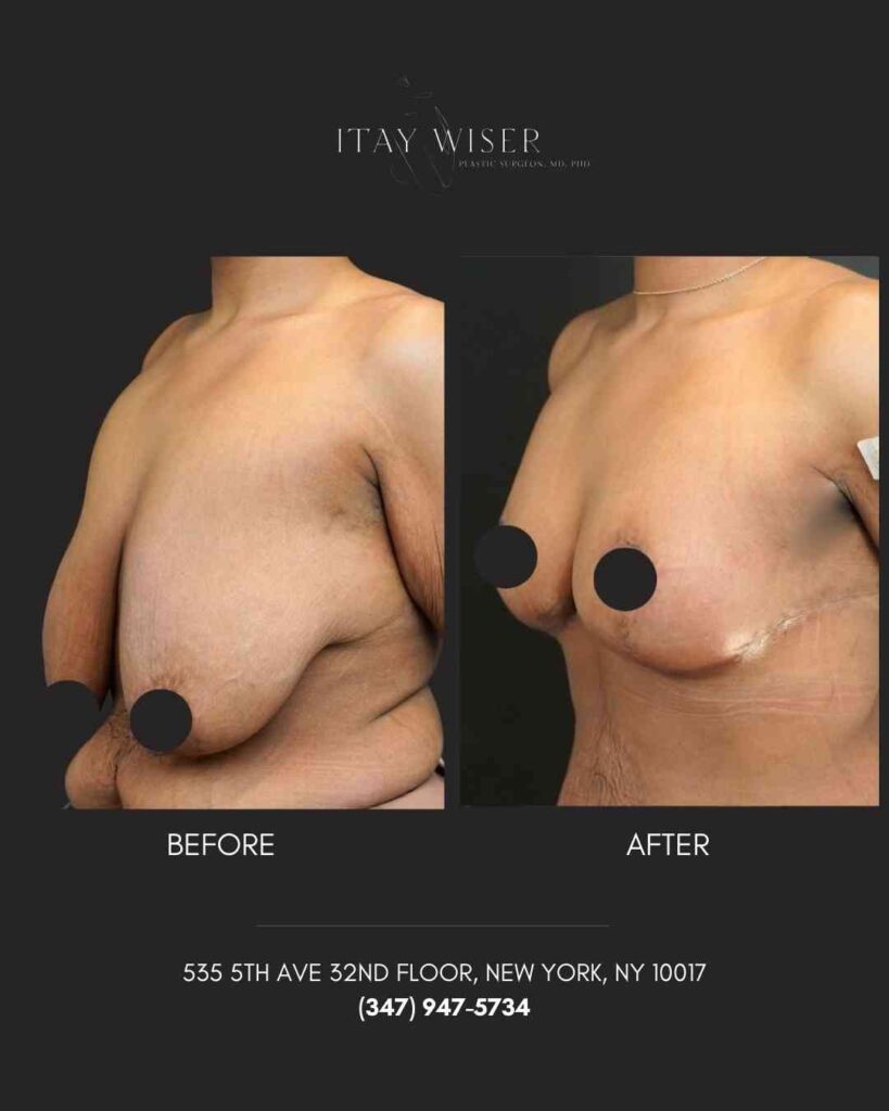 Breast Lift NYC