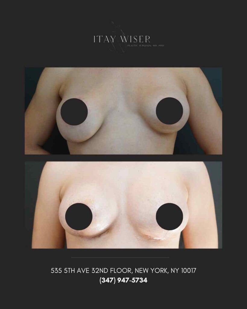 Breast Asymmetry NYC