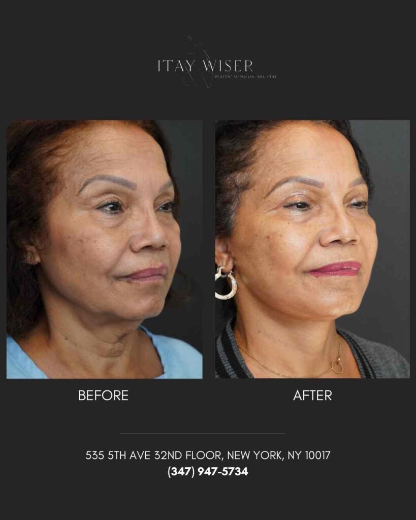 Facelift NYC