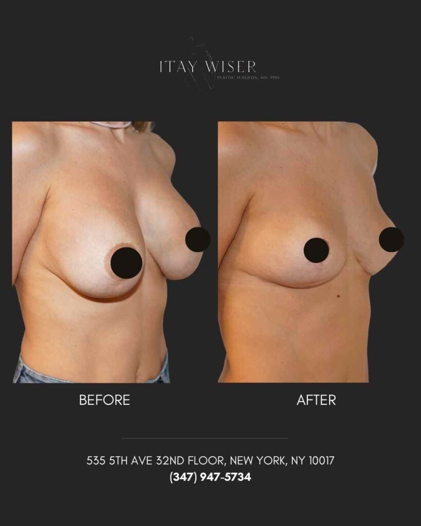 Removal Implants in NYC