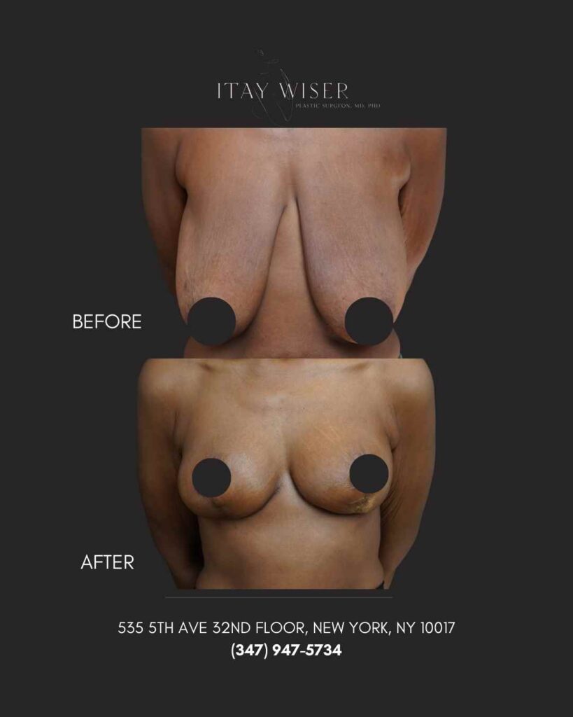 Breast Lift NYC