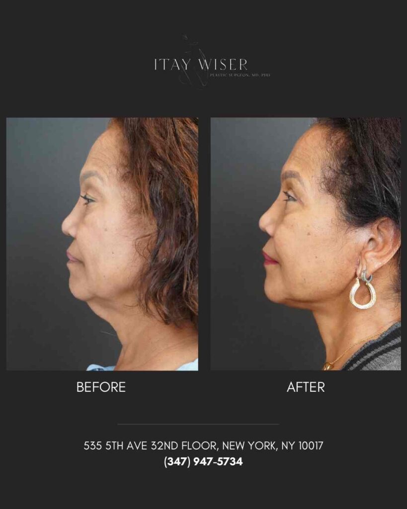 Facelift NYC
