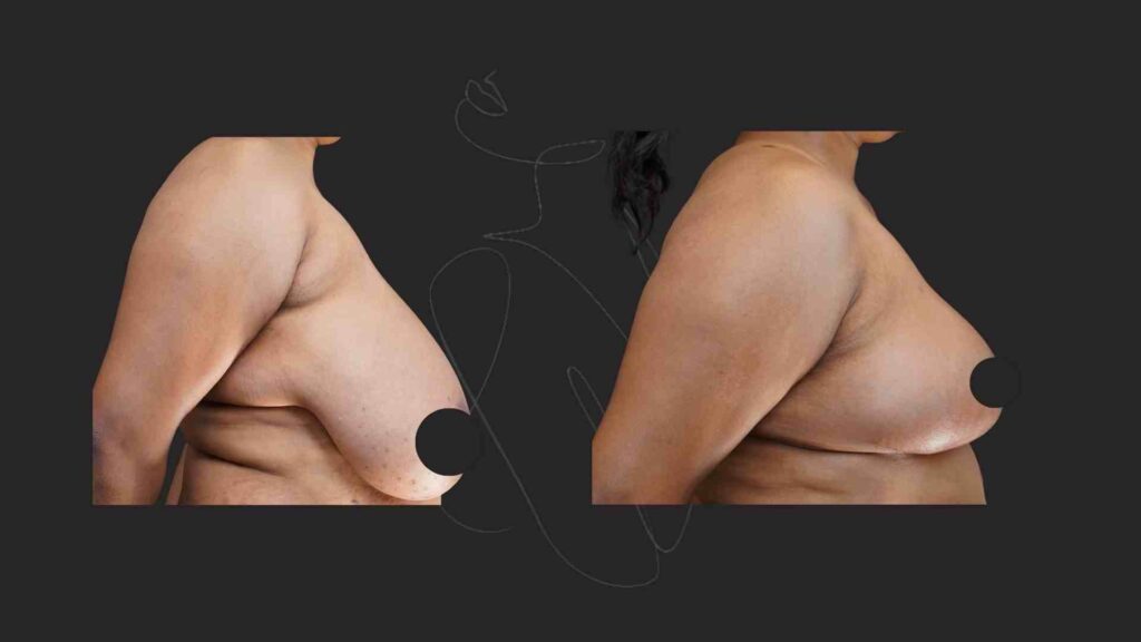 Breast Reduction and Breast Lift