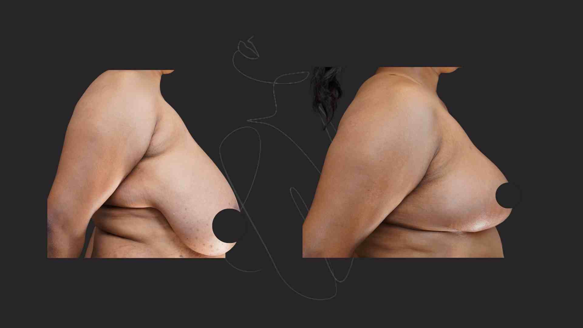 Breast Reduction and Breast Lift