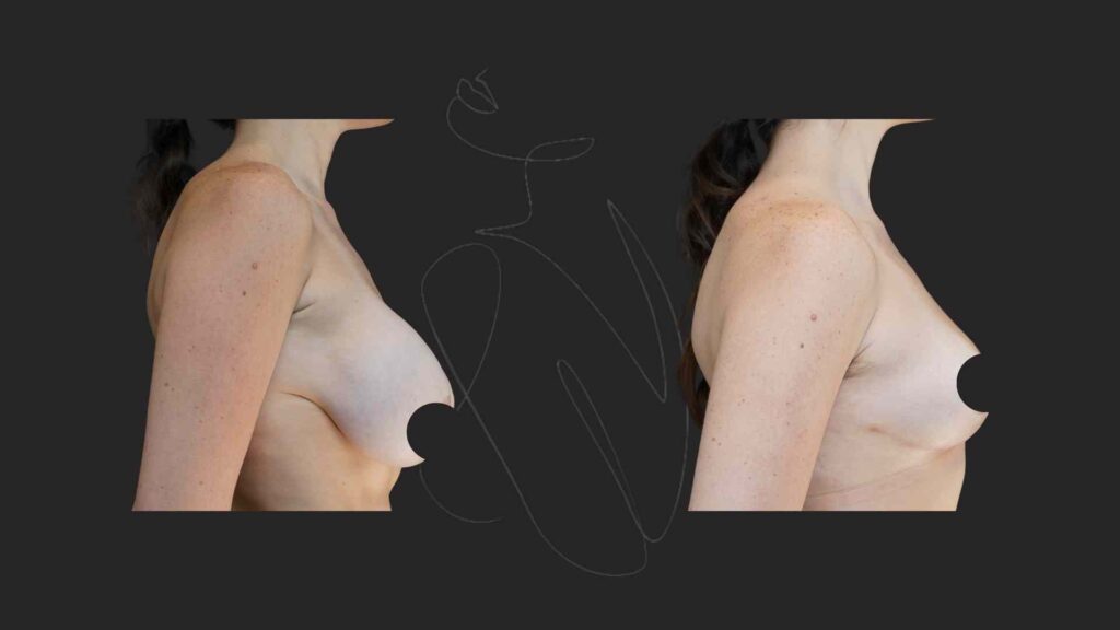 Breast Implant Removal and Breast Lift