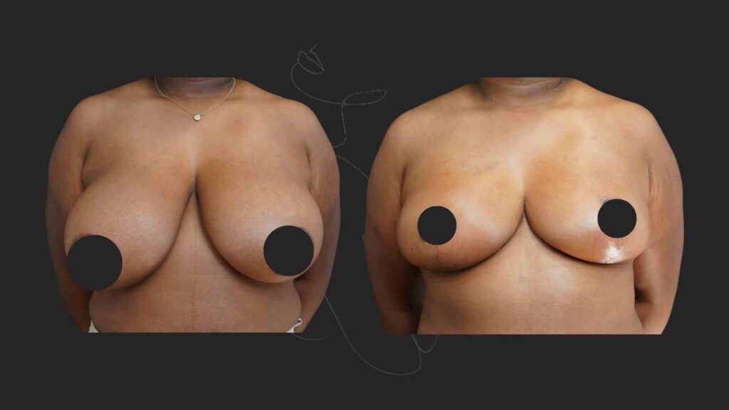 Breast Reduction and Breast Lift