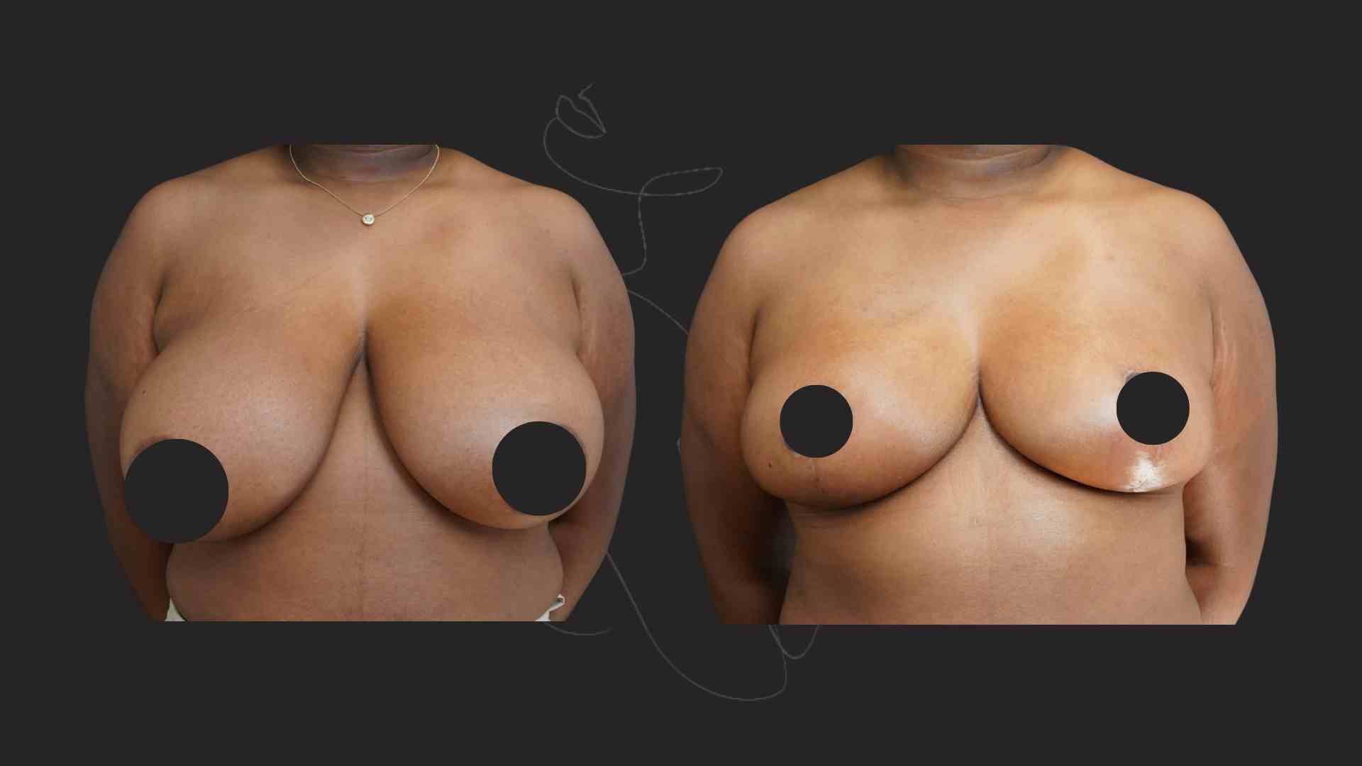 Breast Reduction and Breast Lift