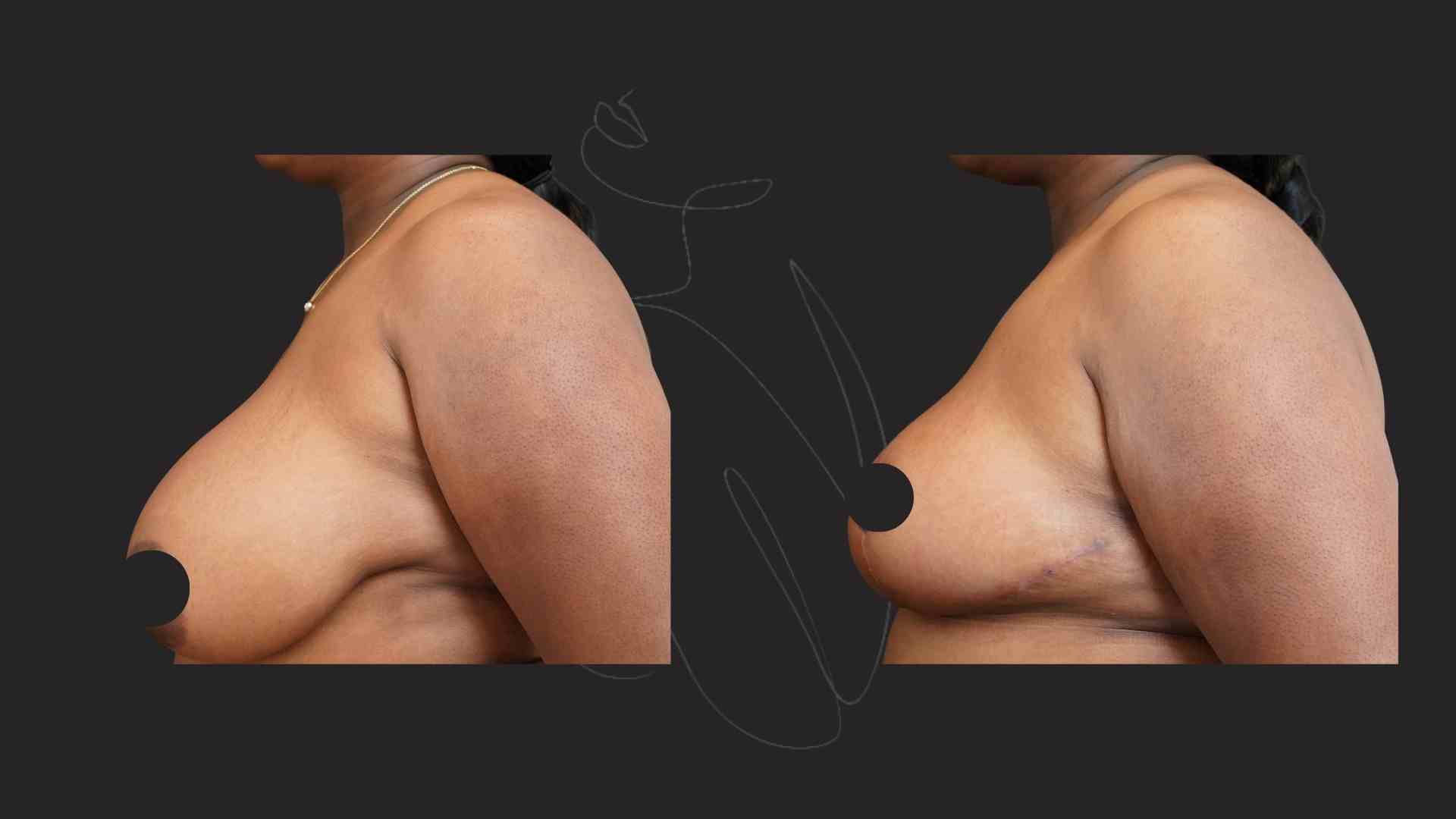 Breast Reduction and Breast Lift