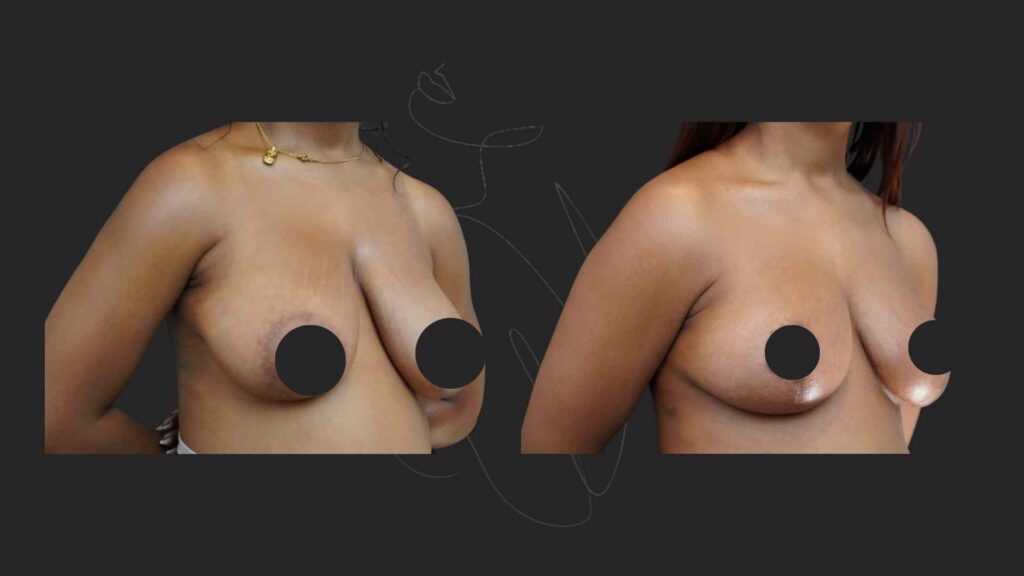 Breast Reduction and Breast Lift