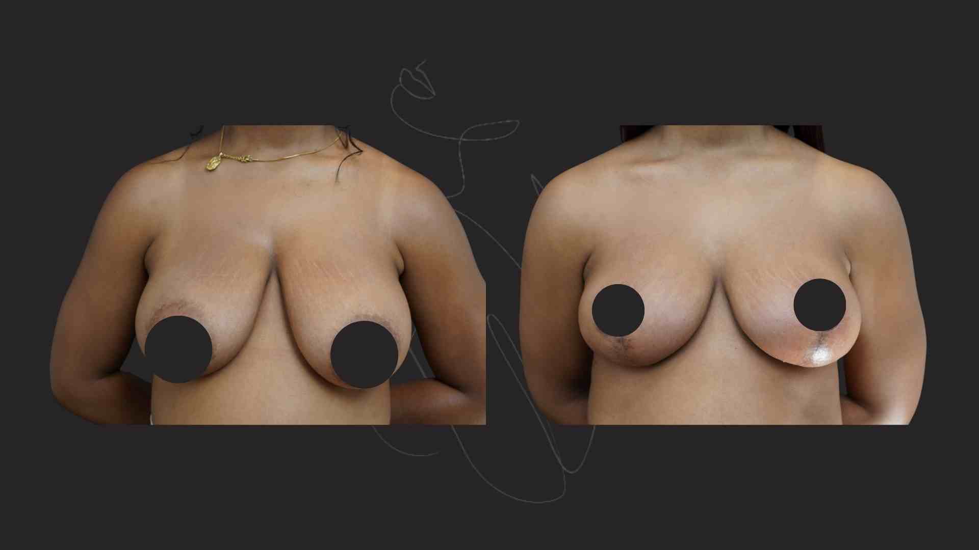 Breast Reduction and Breast Lift